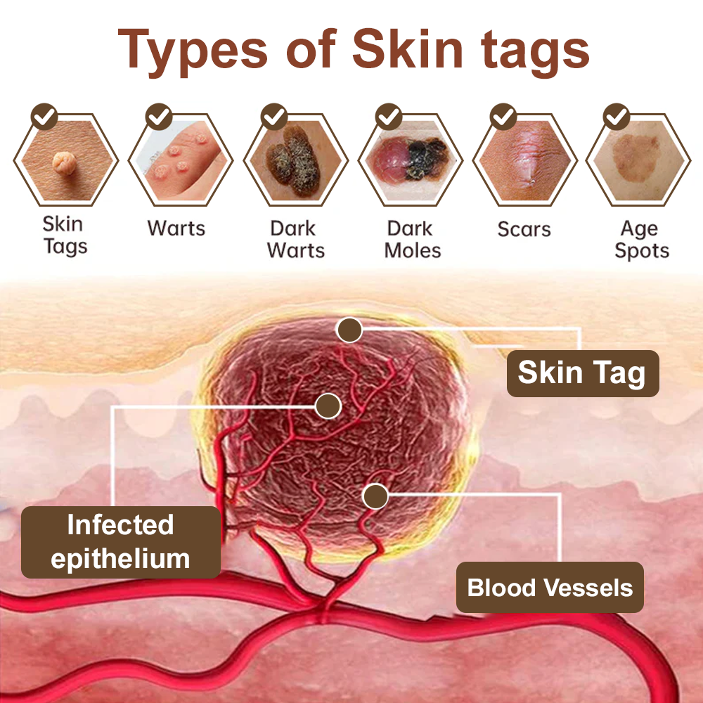 LOVILDS® Black Rice Skin Repair Essence Cream (Removes warts and skin growths, improves keratin buildup and seborrheic dermatitis, follicular keratosis, age spots, and bruising)