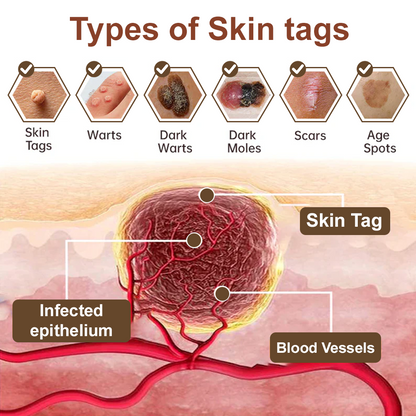 LOVILDS® Black Rice Skin Repair Essence Cream (Removes warts and skin growths, improves keratin buildup and seborrheic dermatitis, follicular keratosis, age spots, and bruising)